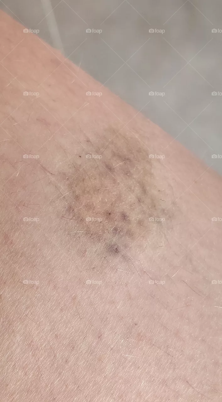 a hematoma on the leg