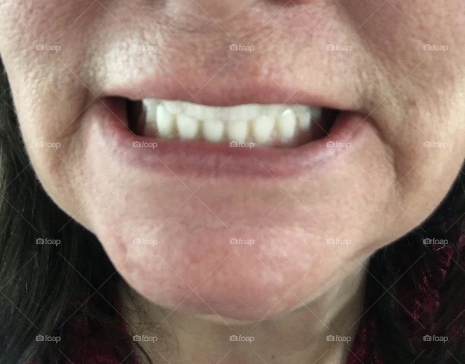 Middle aged lady showing off her new white dentures with a big wide smile