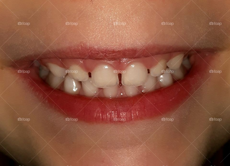 baby teeth / 4 year old / milchzähne