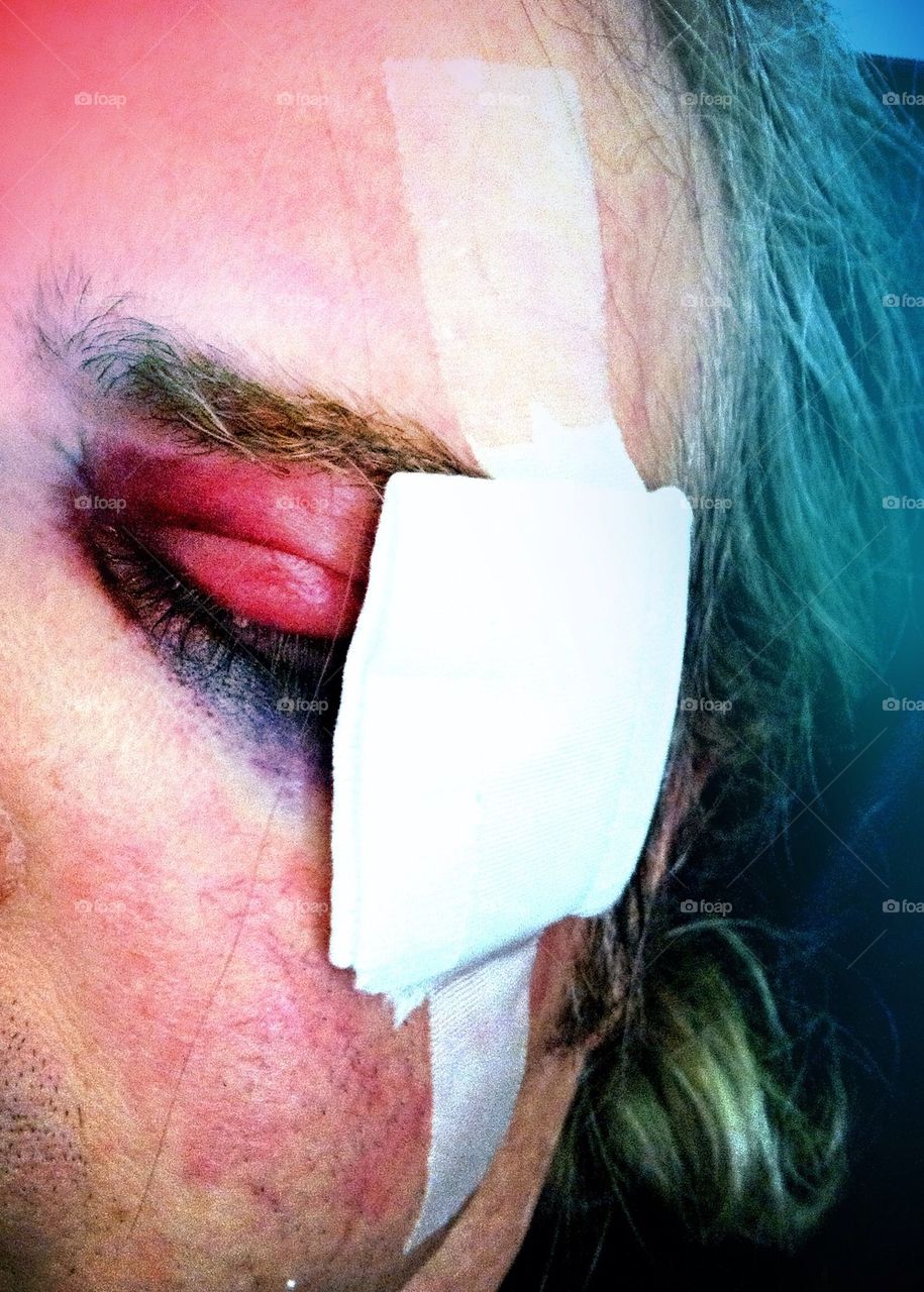 Black eye with bandage