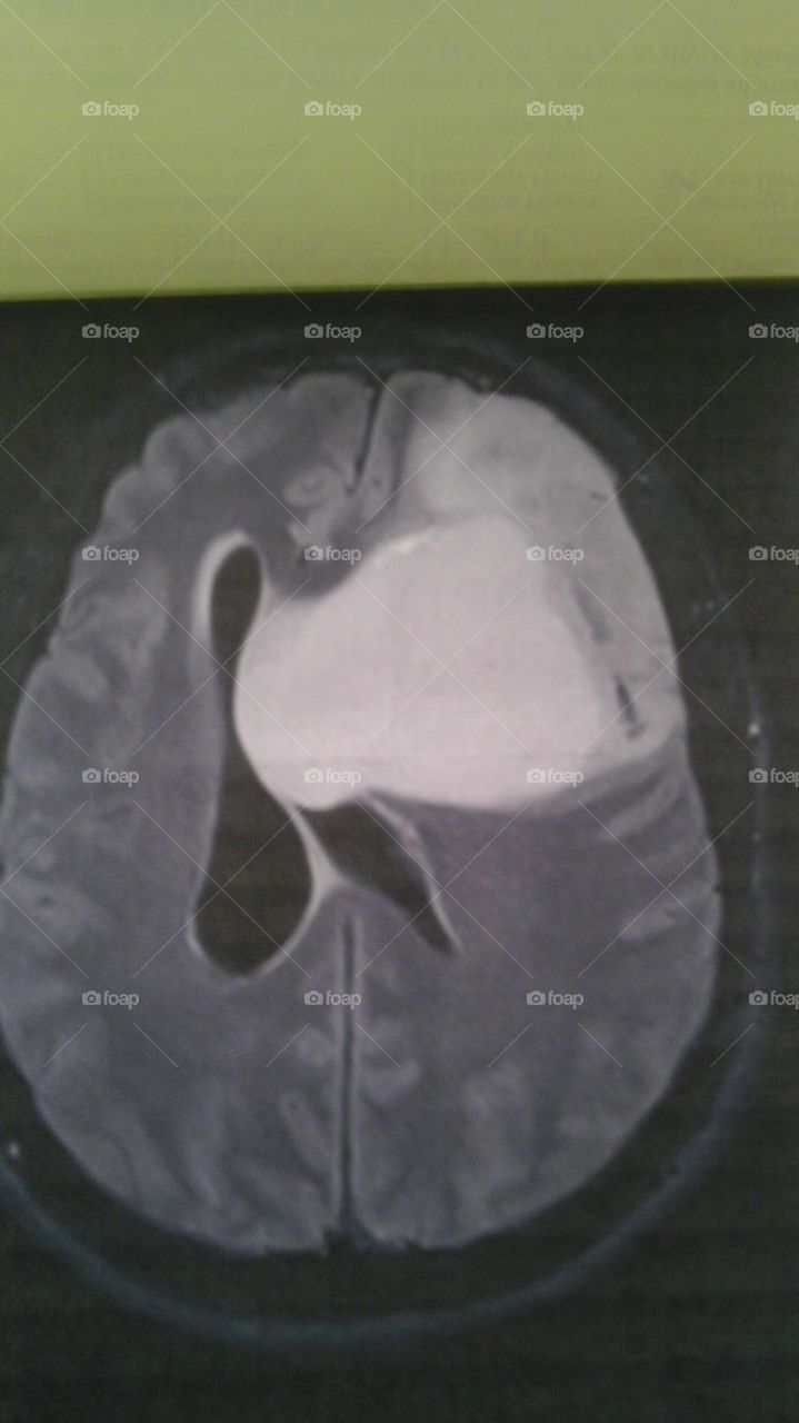 MRI picture