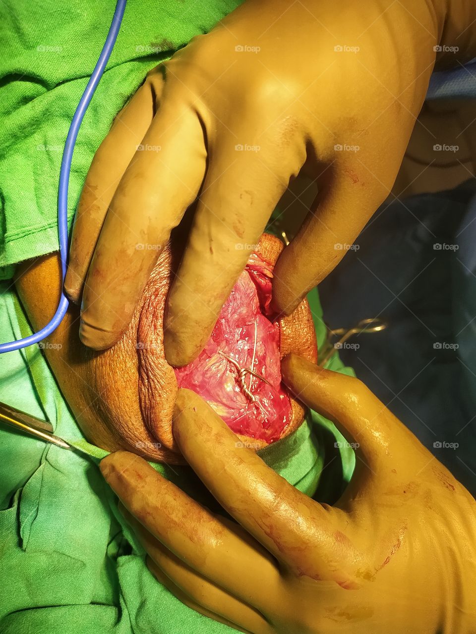 Patella Bone operation theatre close-up shot on Camera