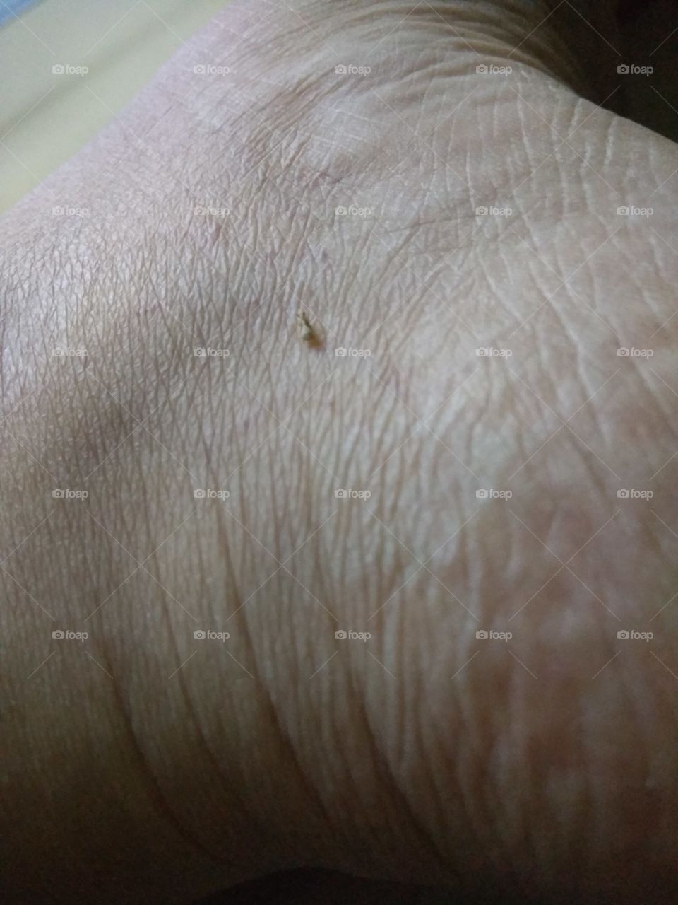 mosquito on the toe