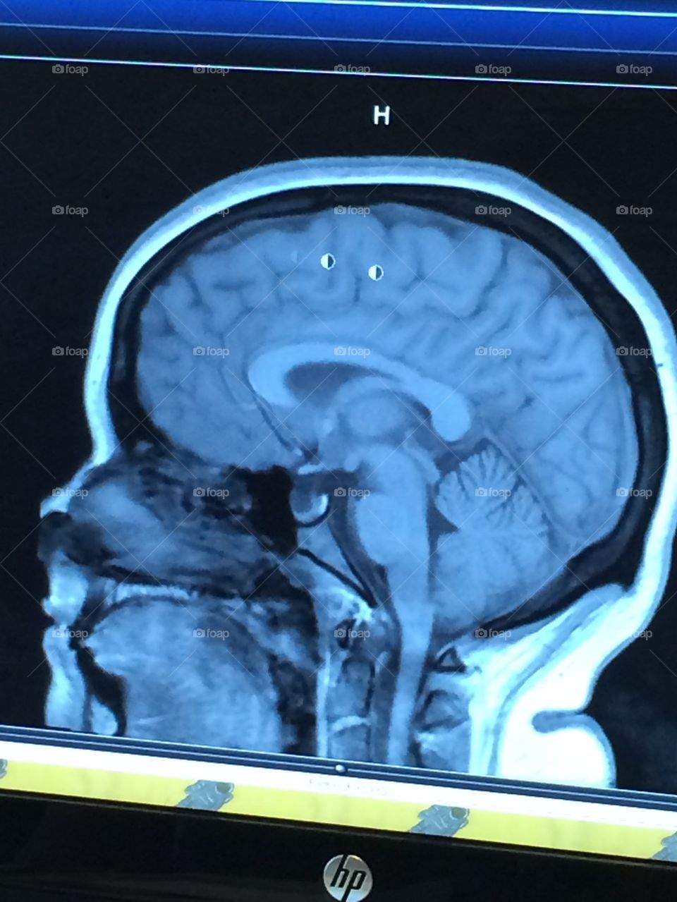 MRI Results 