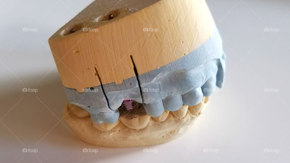 Dental impressions for implant crown