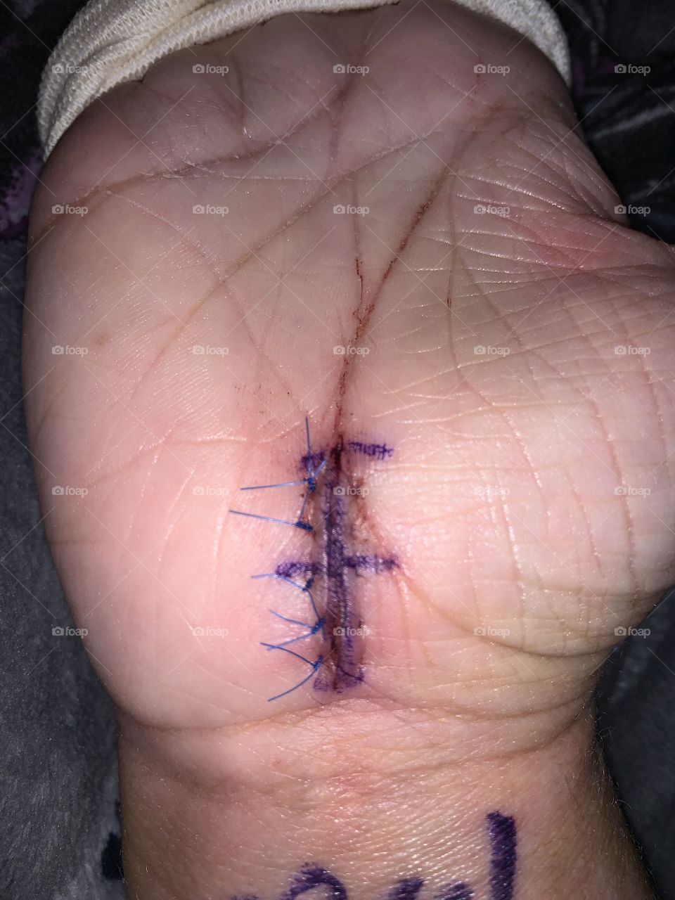 Carpal tunnel surgery 