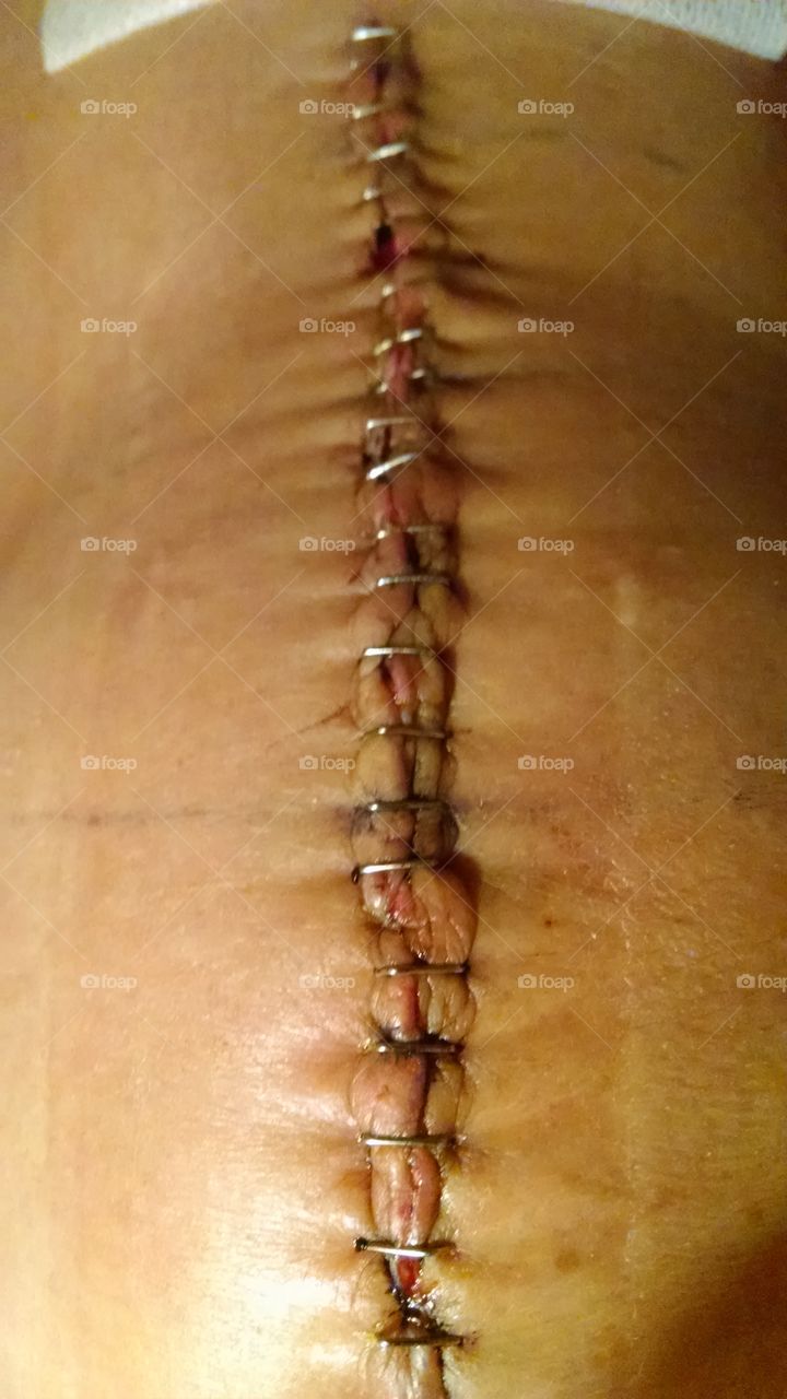 Surgical Staples