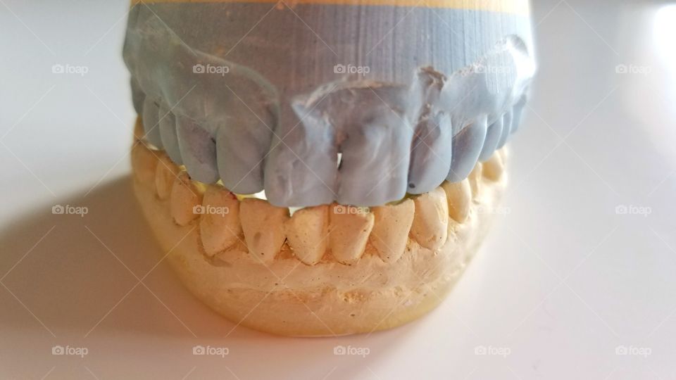 Dental impressions for implants crown