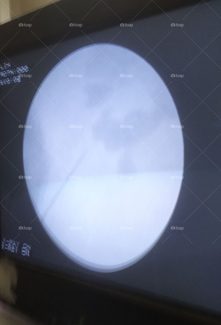 Monitor image of Kidney Stone operation