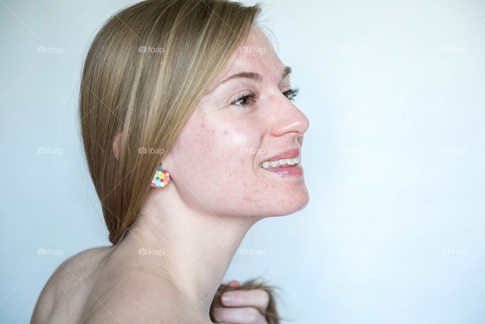Profile portrait of a young millennial woman with acne prone skin smiling