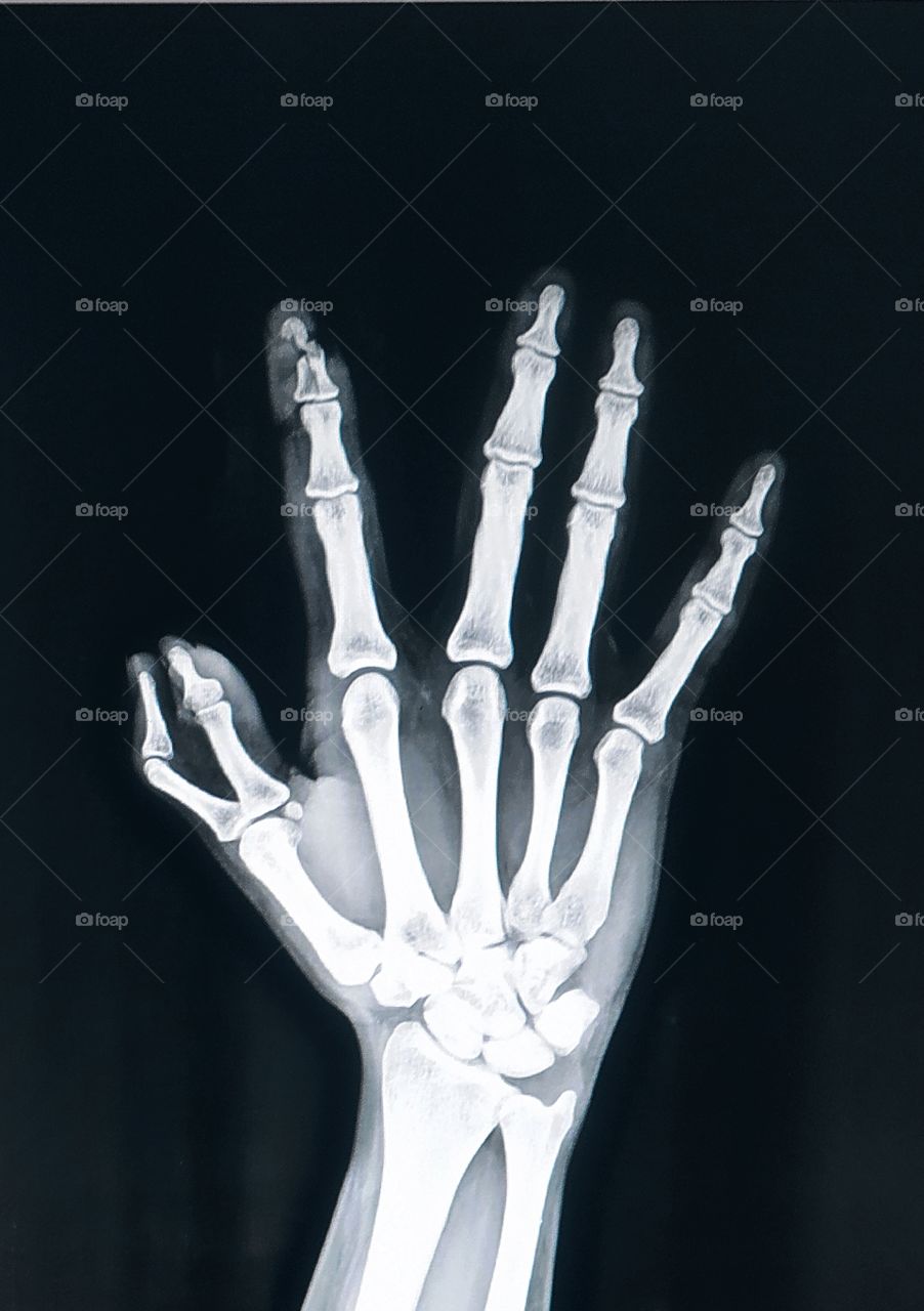 Hand Ap X-ray View shows Fracture in index finger