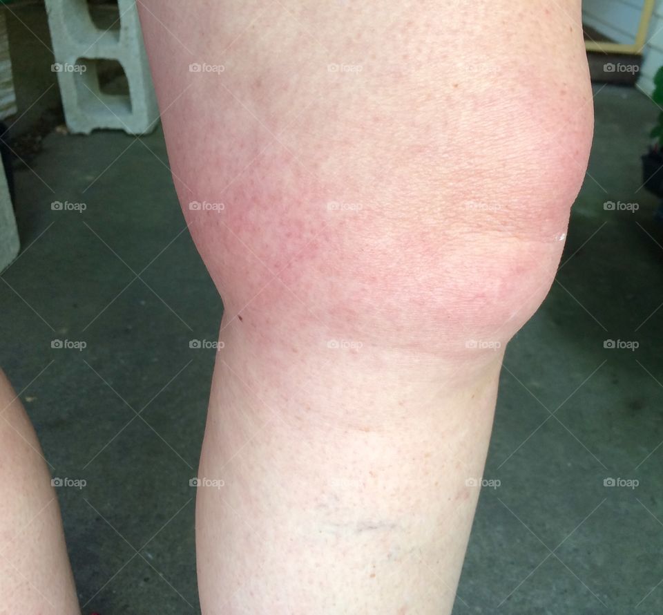 Swollen Knee 