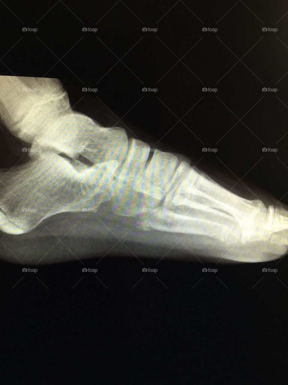 X-Ray of a Foot