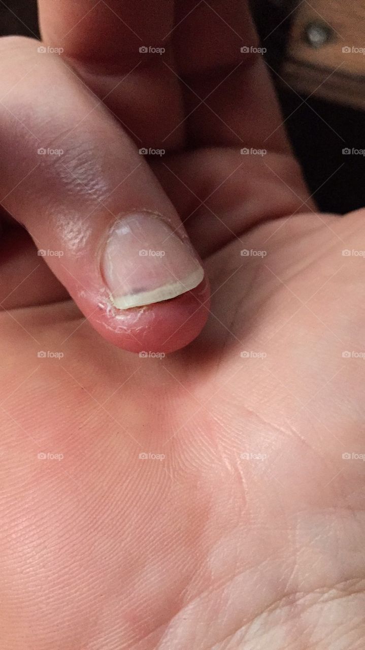 When I amputated the tip of my finger. 