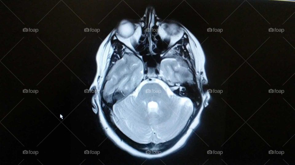 MRI of brain - look inside me