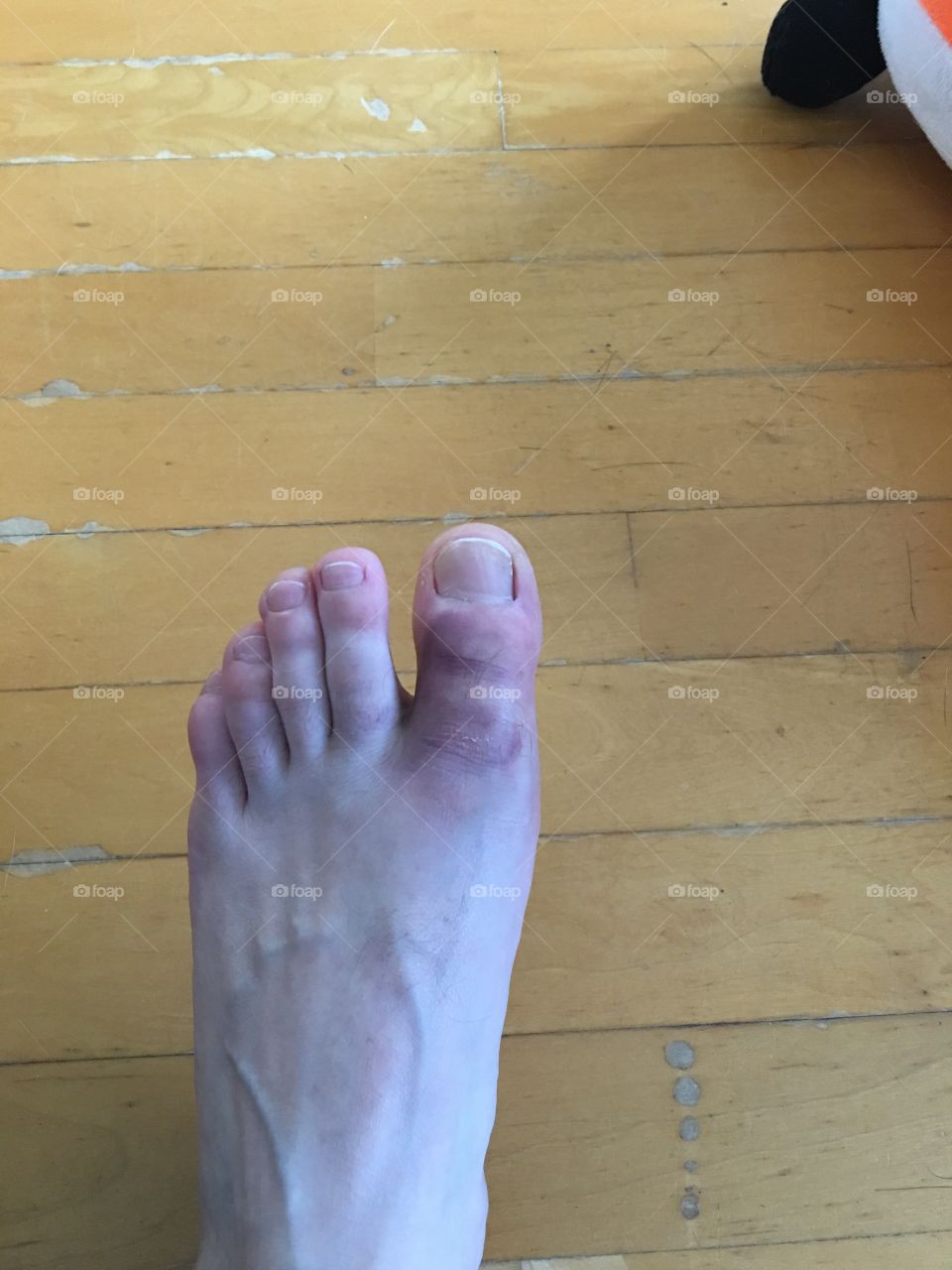 Foot injury 