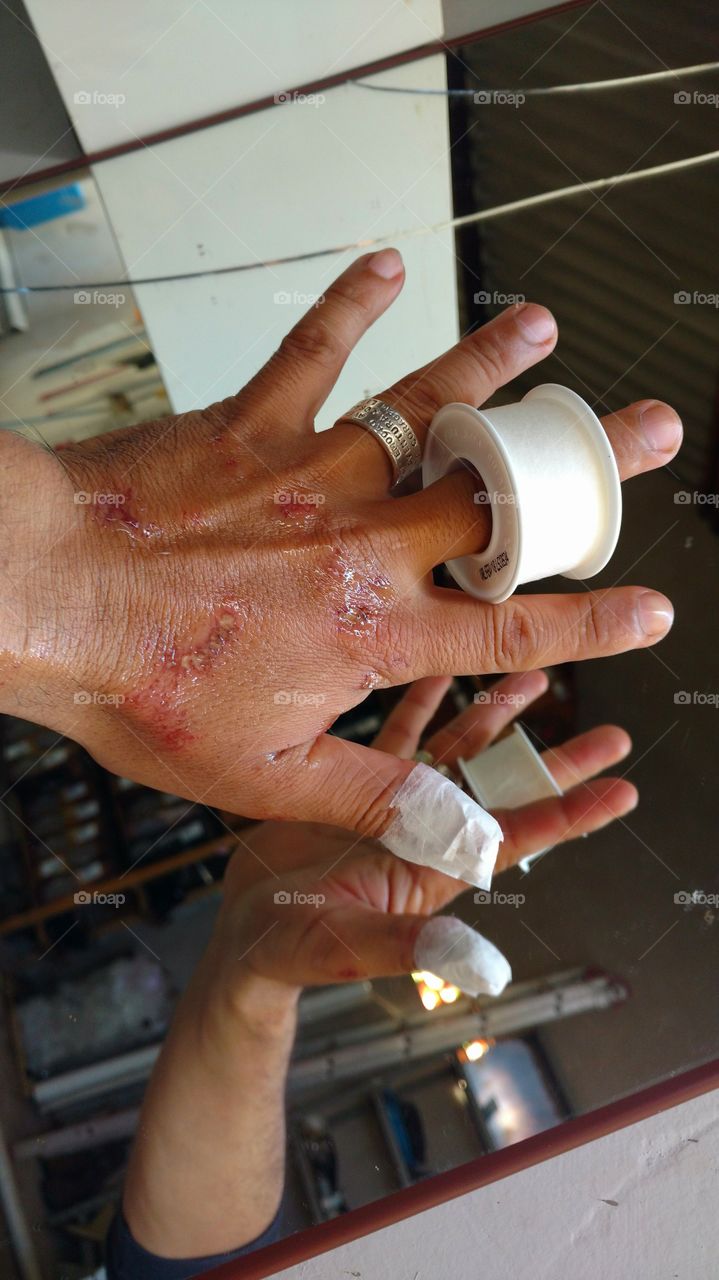 Fita adesiva em mão, para curativos.