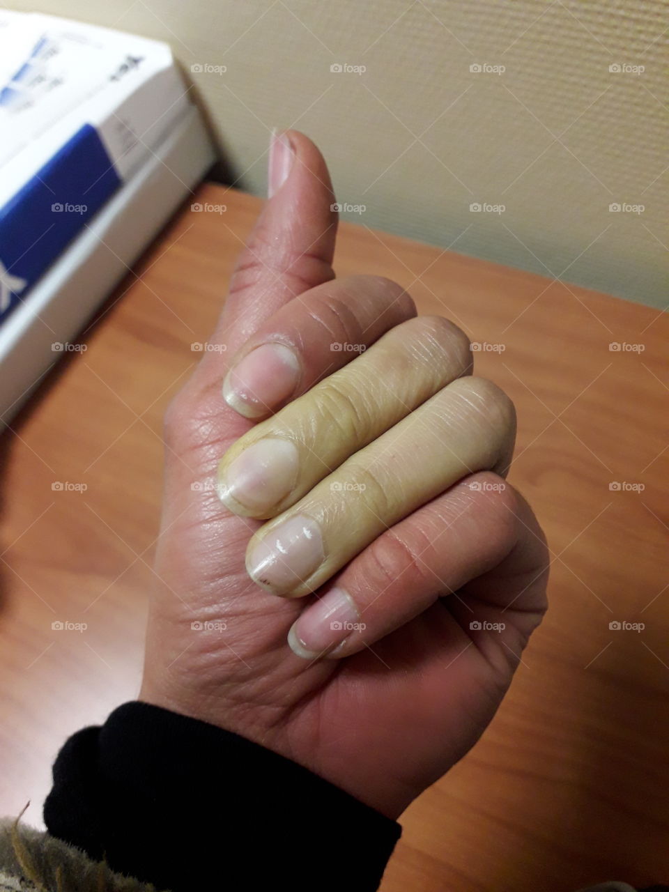 Raynaud