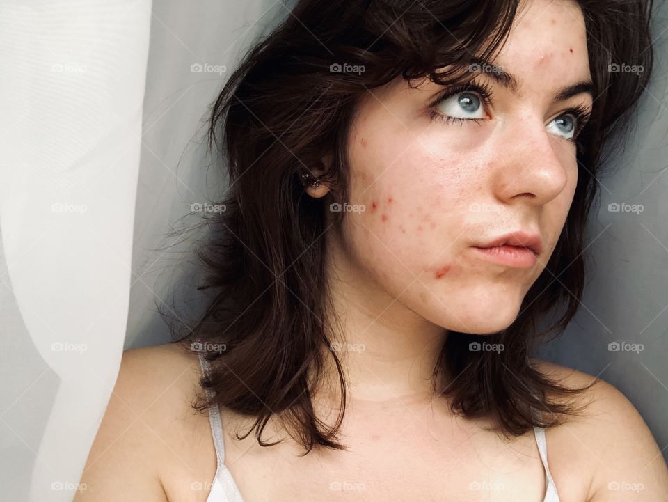 confident, empowered model showing off her acne condition without any makeup covering it