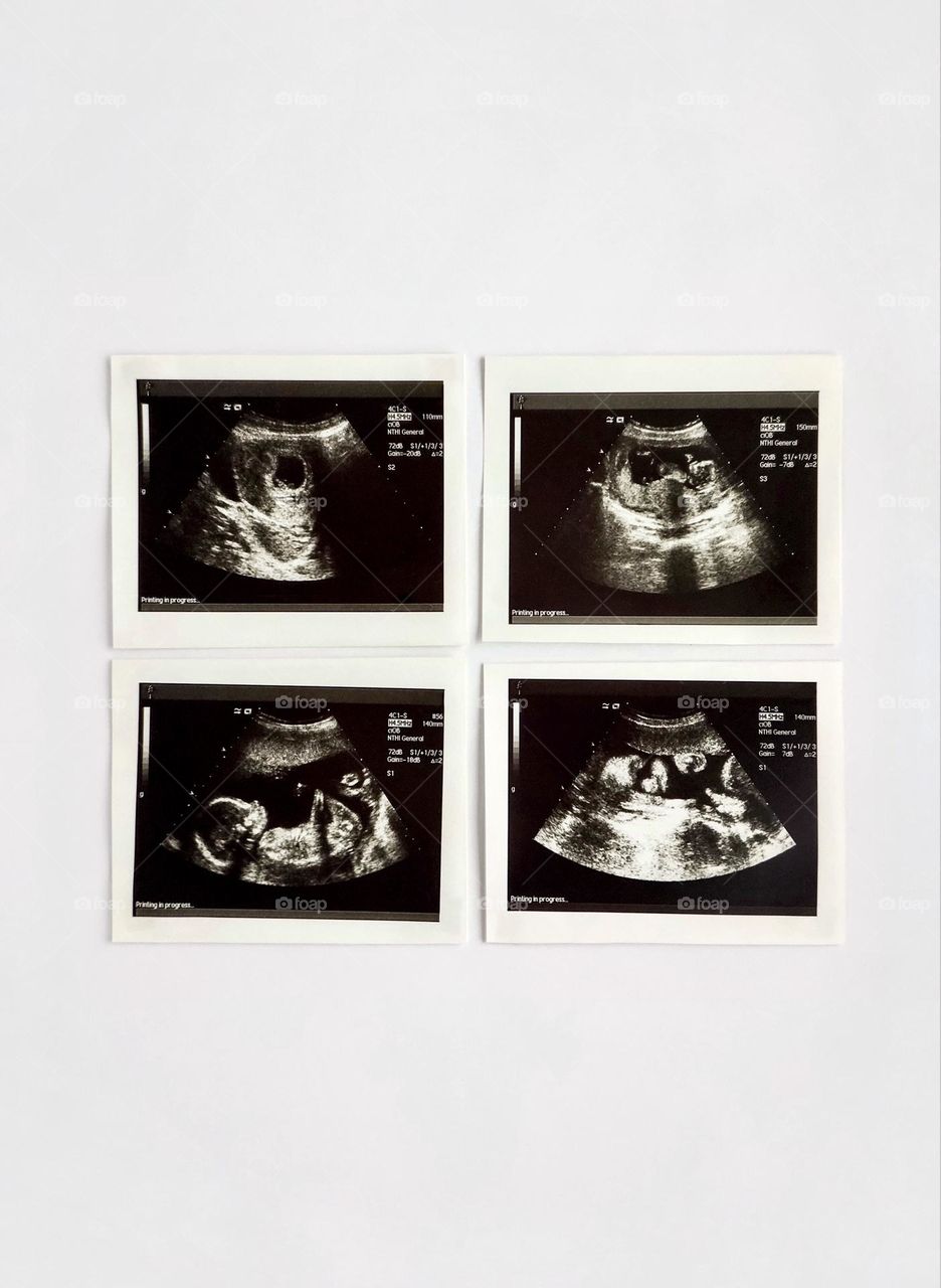Ultrasound pictures, square, pattern, pregnancy