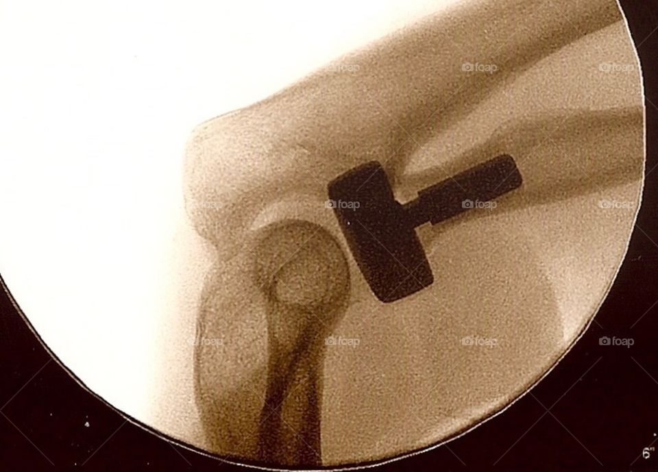 New elbow