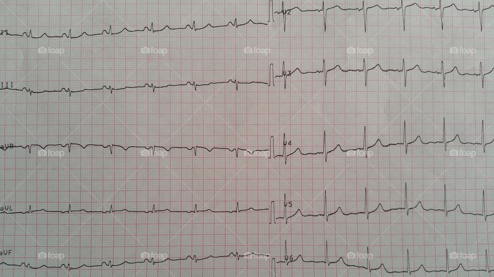 EKG