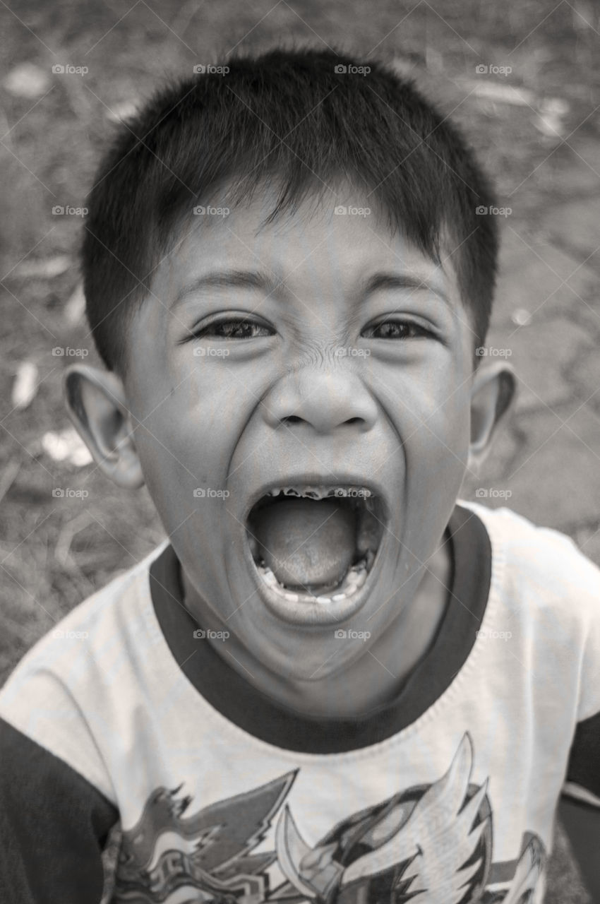 A boy showing his decay teeth