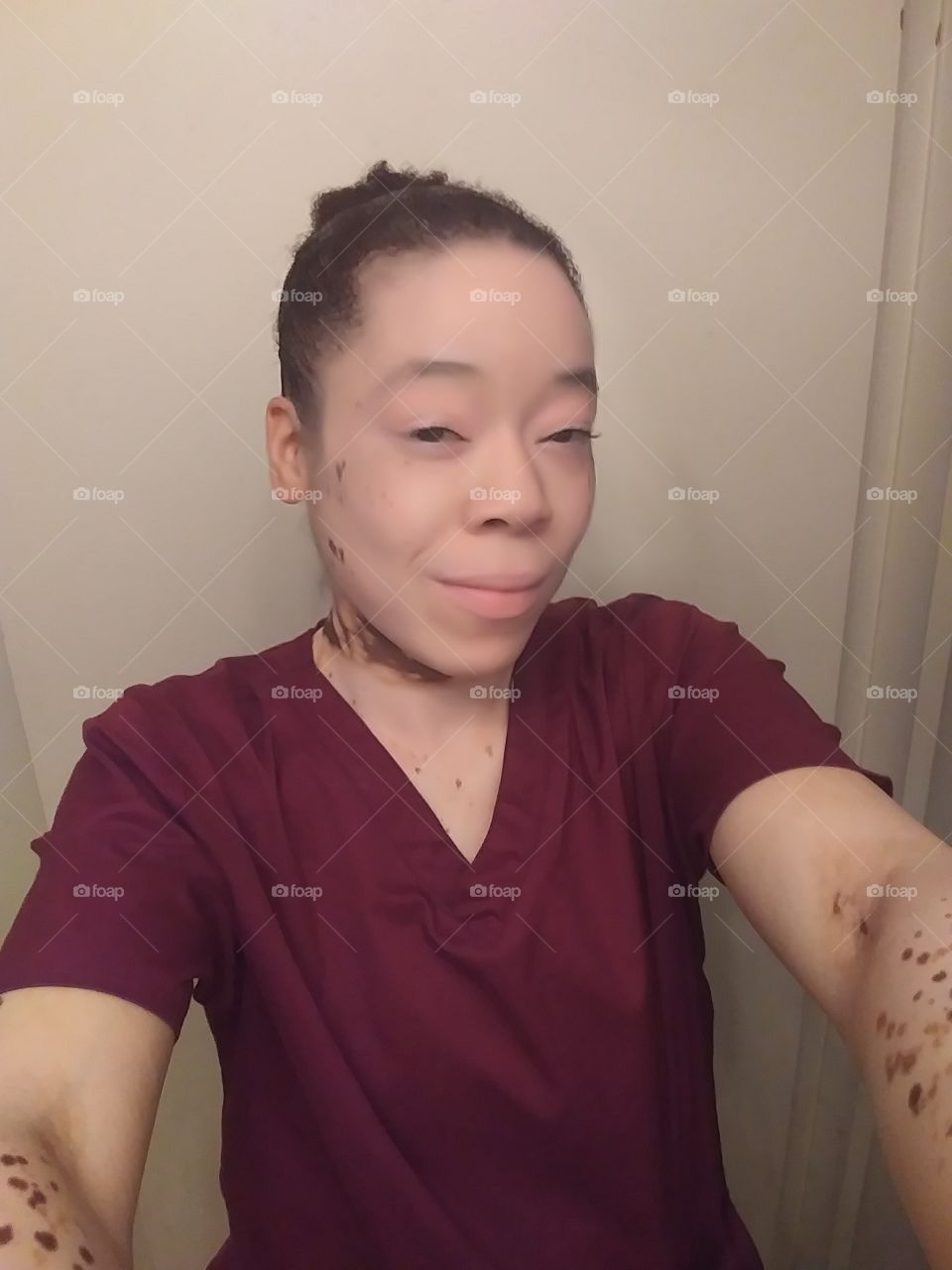 vitiligo queen
