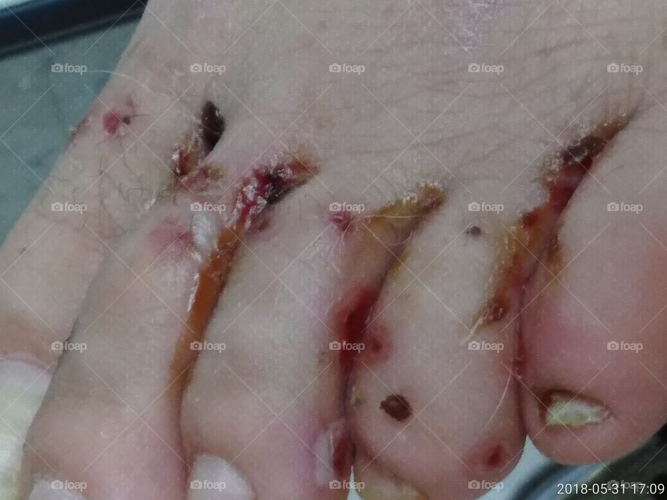 severe infection