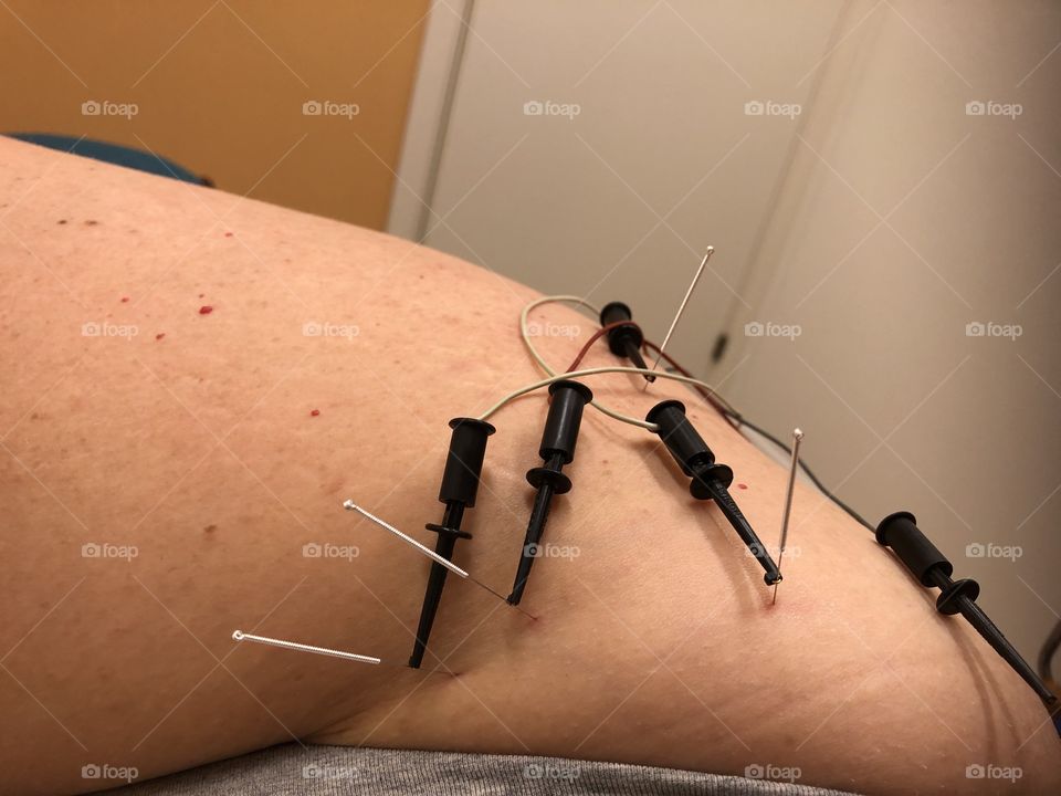 acupuncture