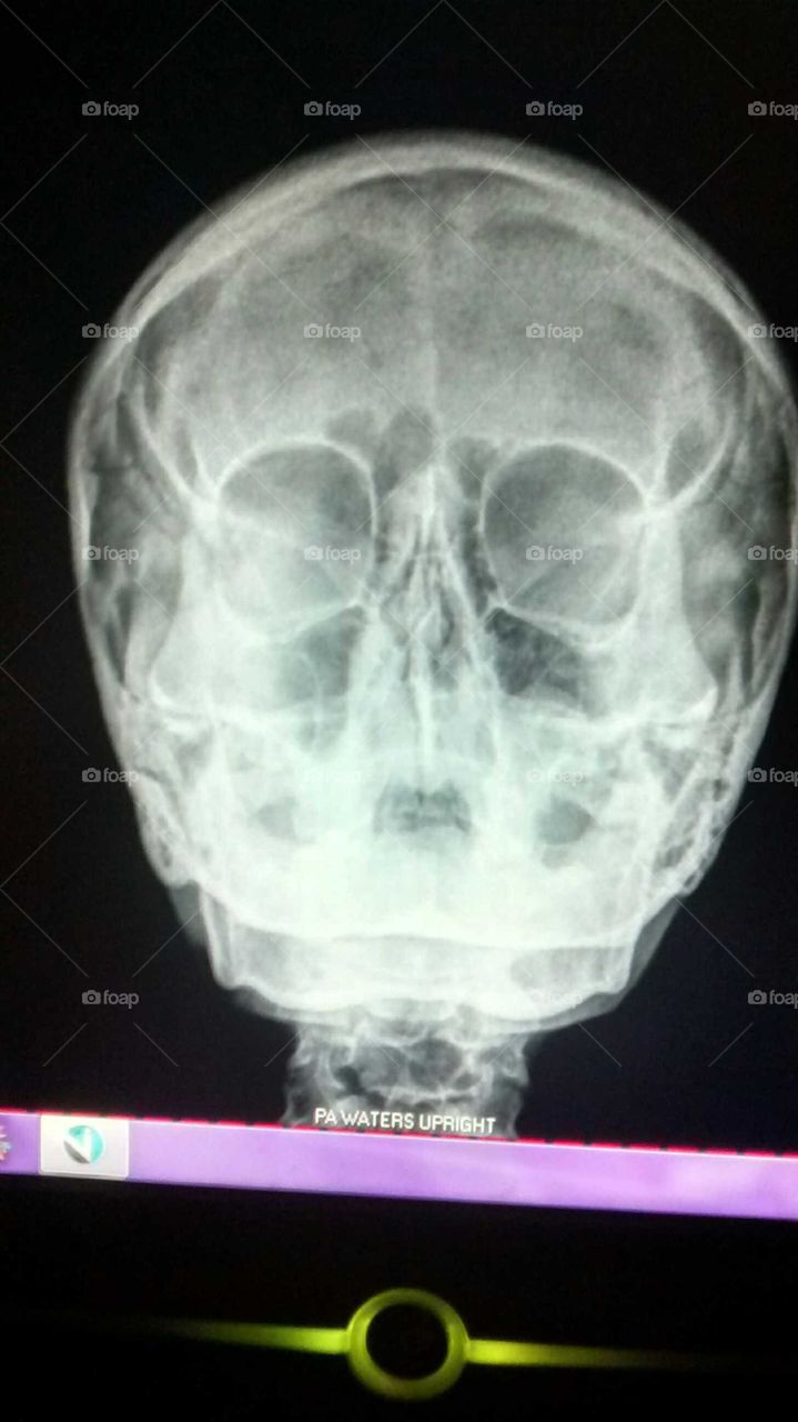 My skull