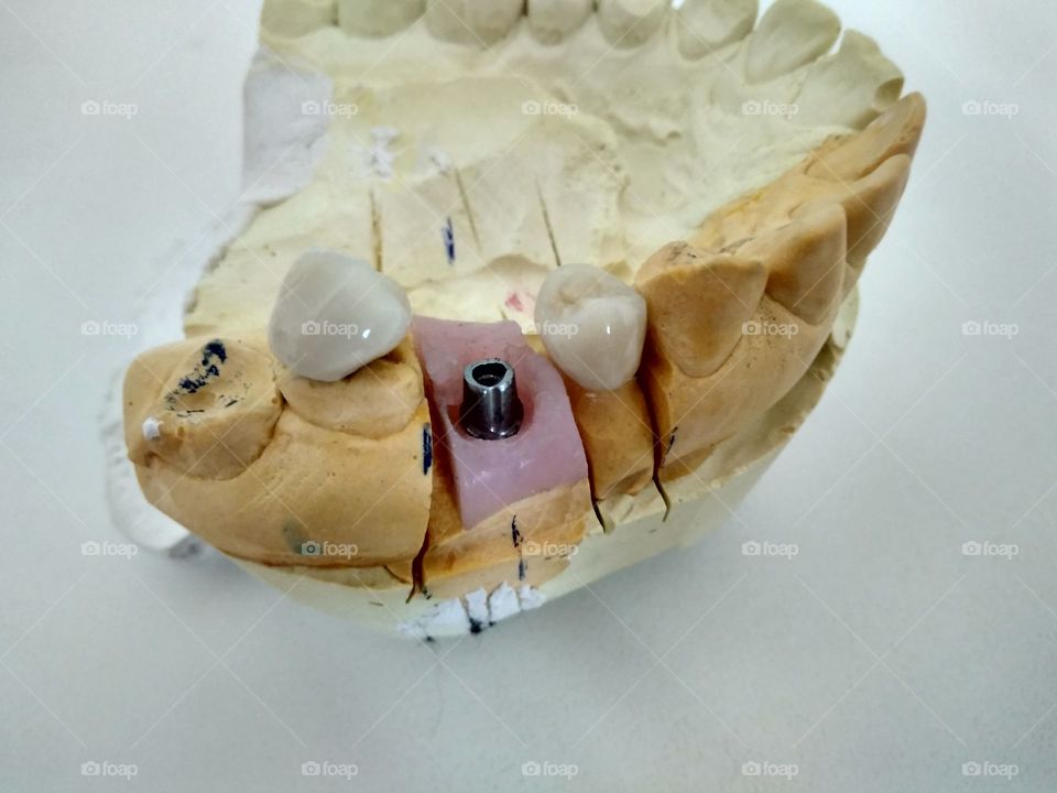 Dental implantation on model