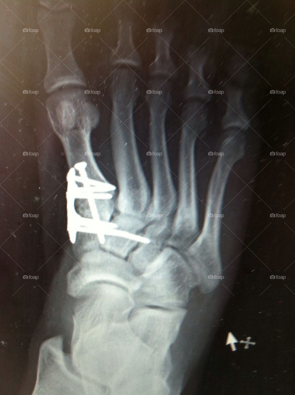 foot screws surgery by chelsea.k.law.5