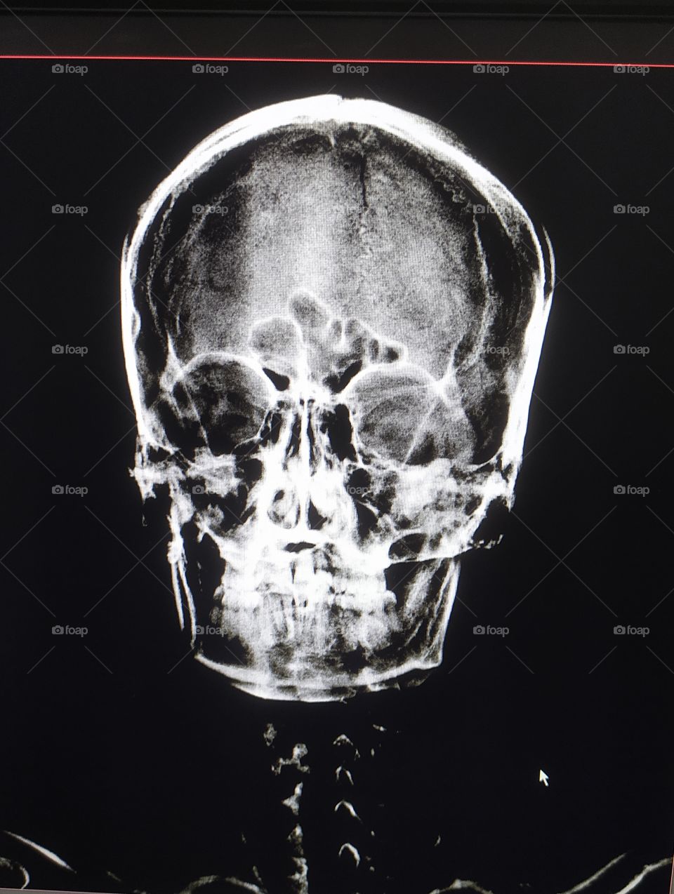 Front face skull xray image