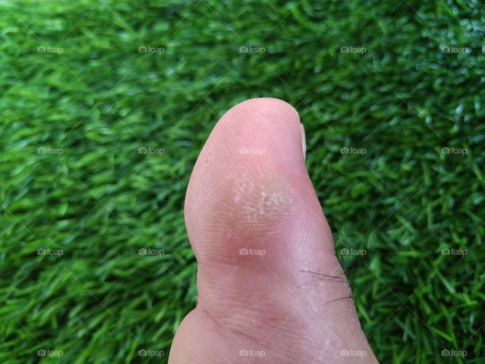 Thickening of the skin of the big toe due to shoe friction