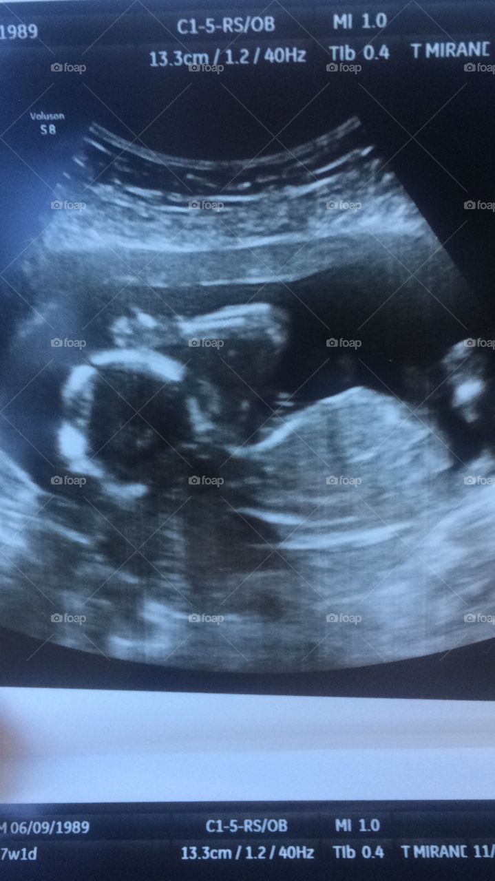Sonogram side view of baby