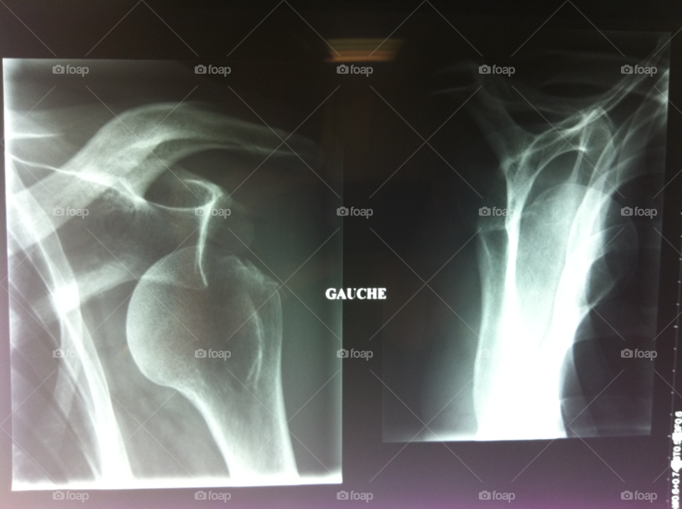 grenoble hospital xray dislocated shoulder by nils