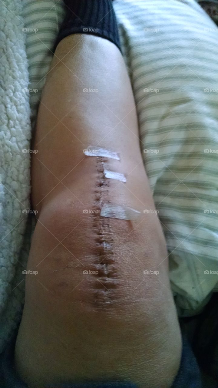 Healing from Total Knee Replacement
