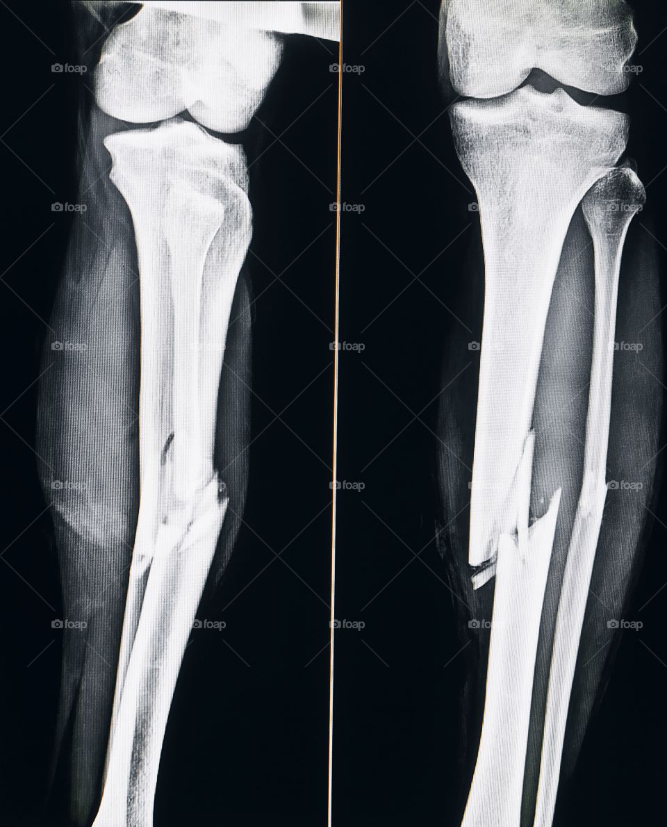 Accidental Tibia fracture X-ray Ap/Lateral View