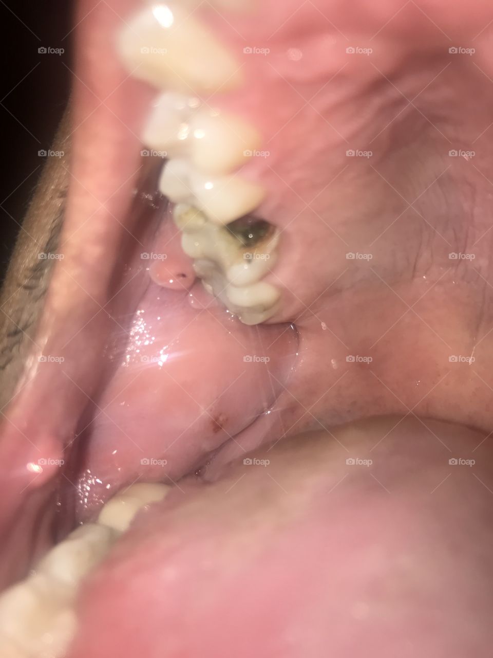 Tooth Bad tooth