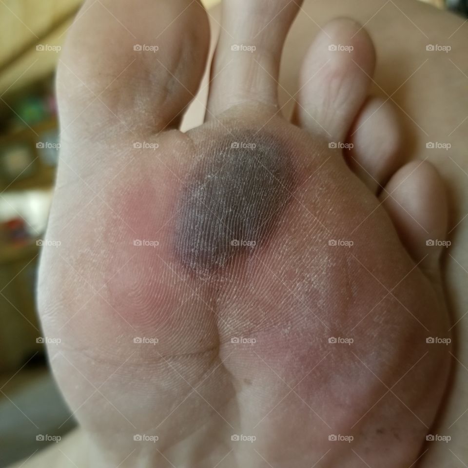Dangers of walking on hot pavement