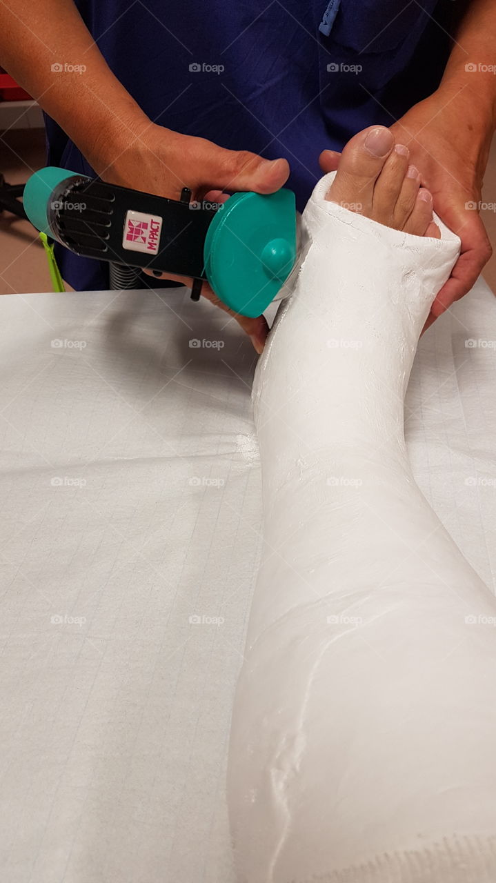 Taking short leg cast off at the hospital by a cast saw - avgipsning av underben med gipssåg på sjukhus