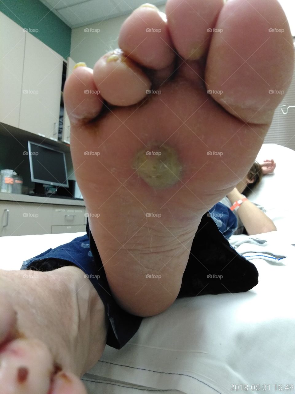 severe blister on foot