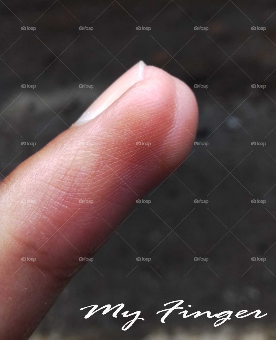 scar finger